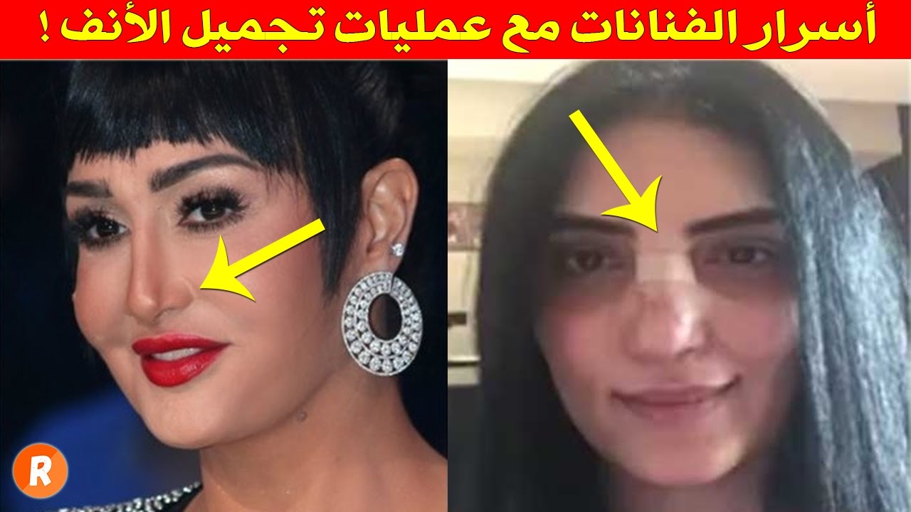 عملية تجميل قبل و بعد - صور واضحه جدا لعمليات التجميل 6689 1