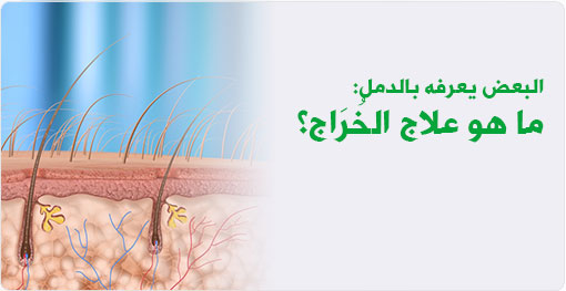 علاج الخراج - احدث علاجات الخراج 4233 3