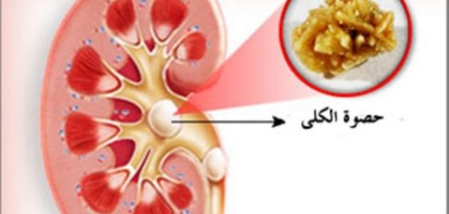 كيفية علاج رمل الكلى - علاج رمل الكلى 1396 1