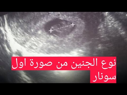 علامات الحمل بولد في الشهر الثاني 2501 1