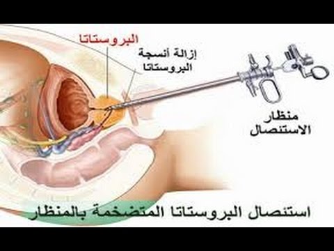 اعراض البروستاتا - تعرف على مرض البروستاتا 1989 1