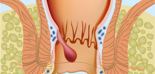 مرض البواسير - اسبابة واعراضة وعلاجة 2645 2