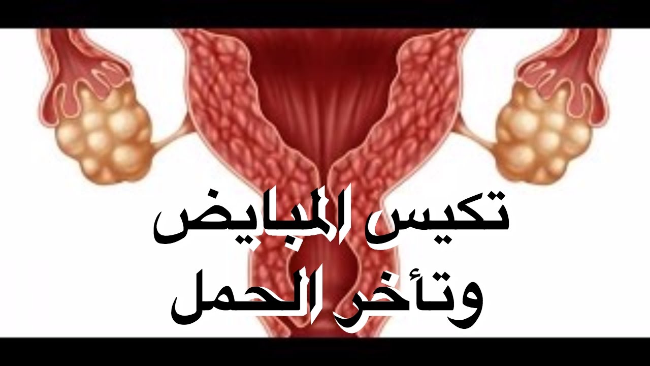 علاج ضعف المبايض 3492 12