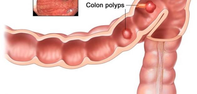 مرض القولون , ماهى اعراض المتعلقه بالقولون