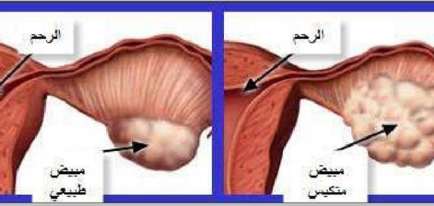 اعراض تكيس المبايض , ما هو تكيس المبايض