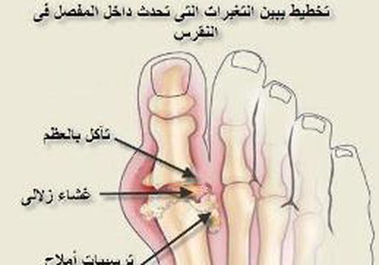 مرض النقرس - اعراض مرض النقرس 6459 1