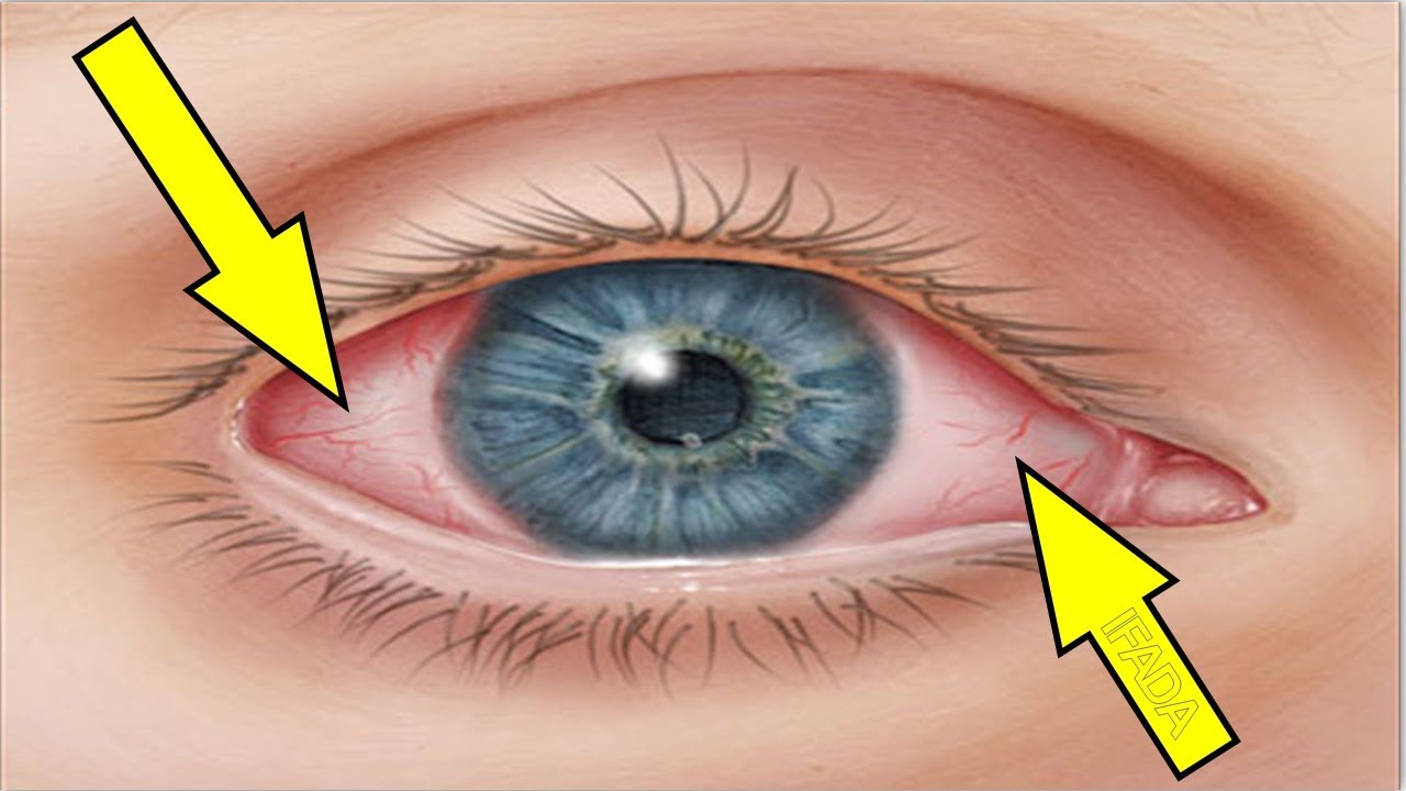 الاسباب التى تؤدي الي احمرار العين - العين الحمراء 3578 11