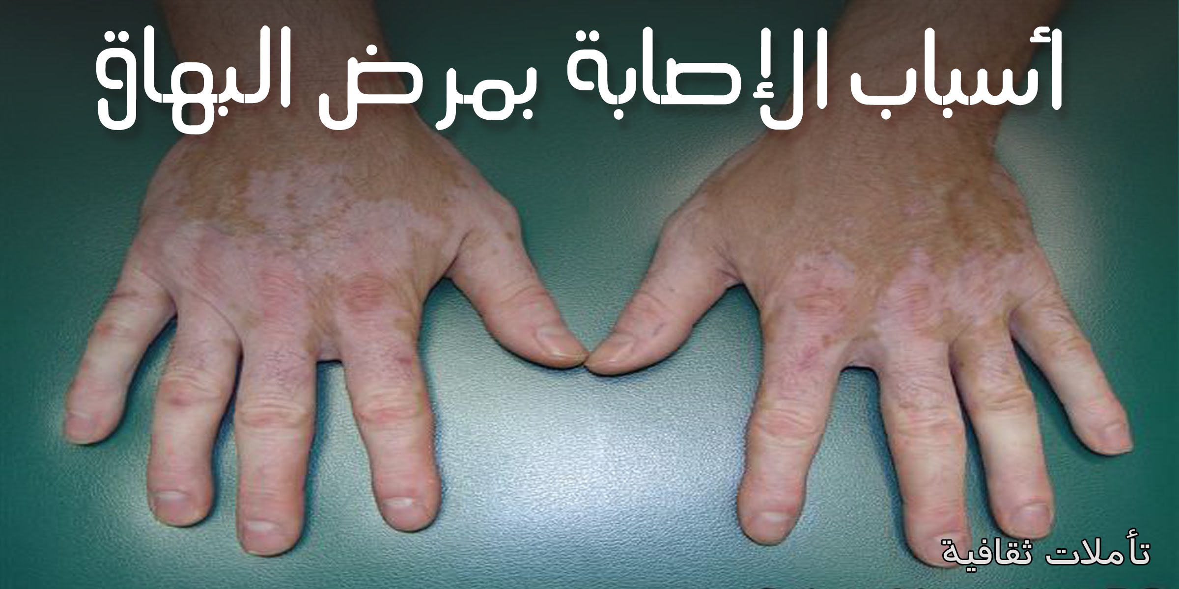 علاج البهاق بالاعشاب - وصفه مضمونه ومجربه لعلاج البهاق 3170 2