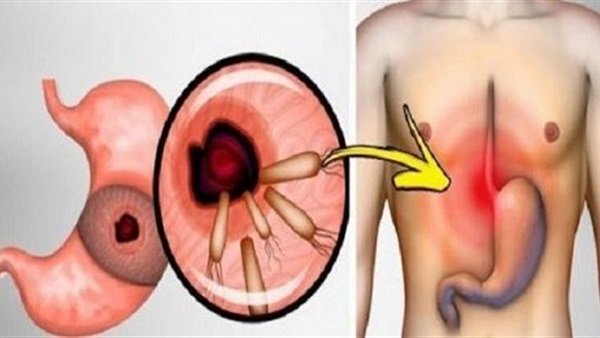 خطورة جرثومة المعدة - اعراض جرثومة المعدة   1626 1