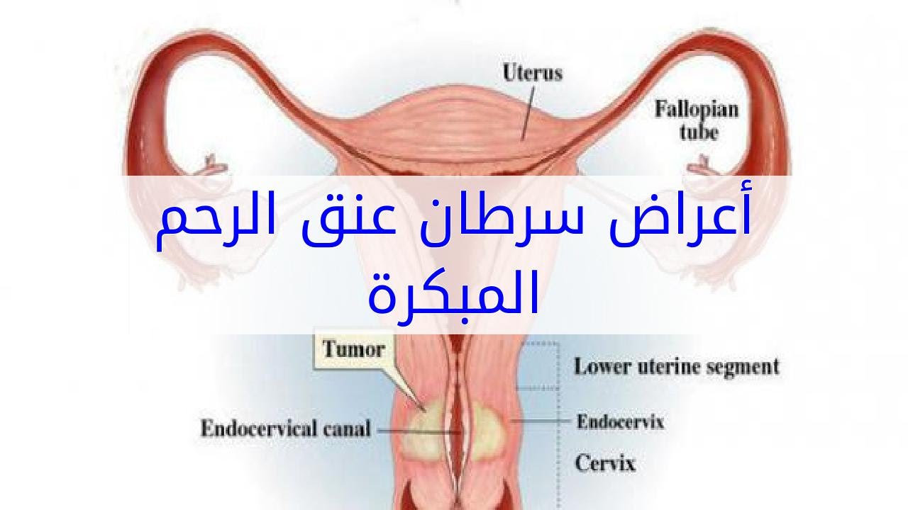 اعراض سرطان الرحم - ما هو سرطان الرحم 1885