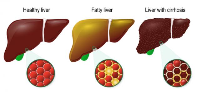 اضرار تليف الكبد - اعراض تليف الكبد 2483 1
