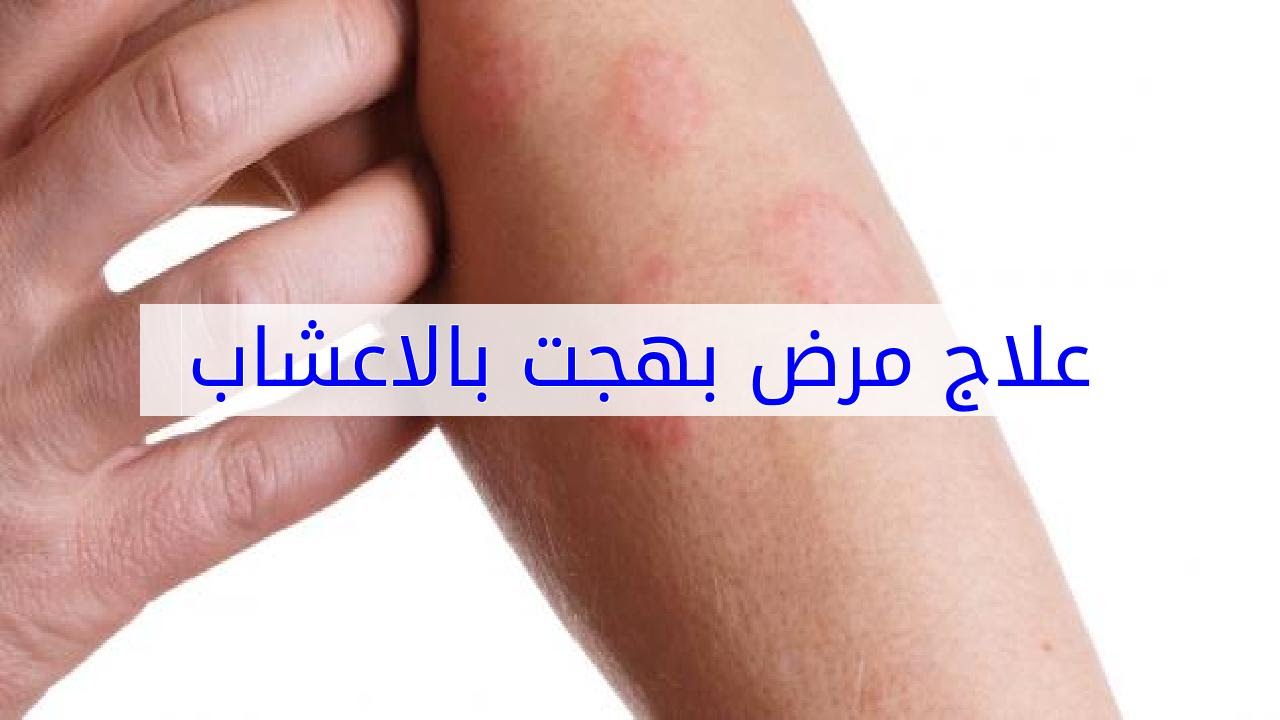 مرض بهجت - حقائق هامة عن هذا المرض النادر 5657 3