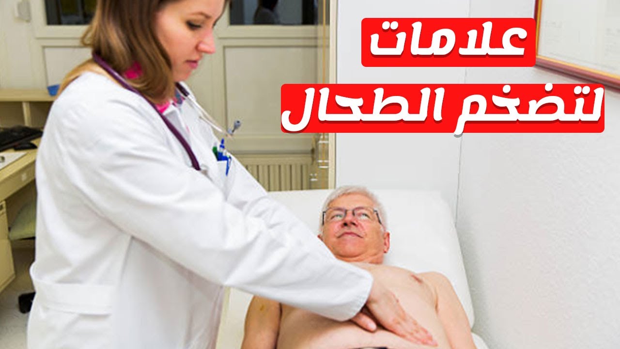 تضخم الطحال - علاج تضخم الطحال 4039