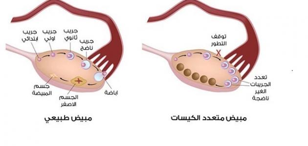 اعراض تكيس المبايض - ما هو تكيس المبايض 6487 1