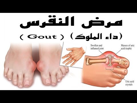 مرض النقرس - اعراض مرض النقرس 6459