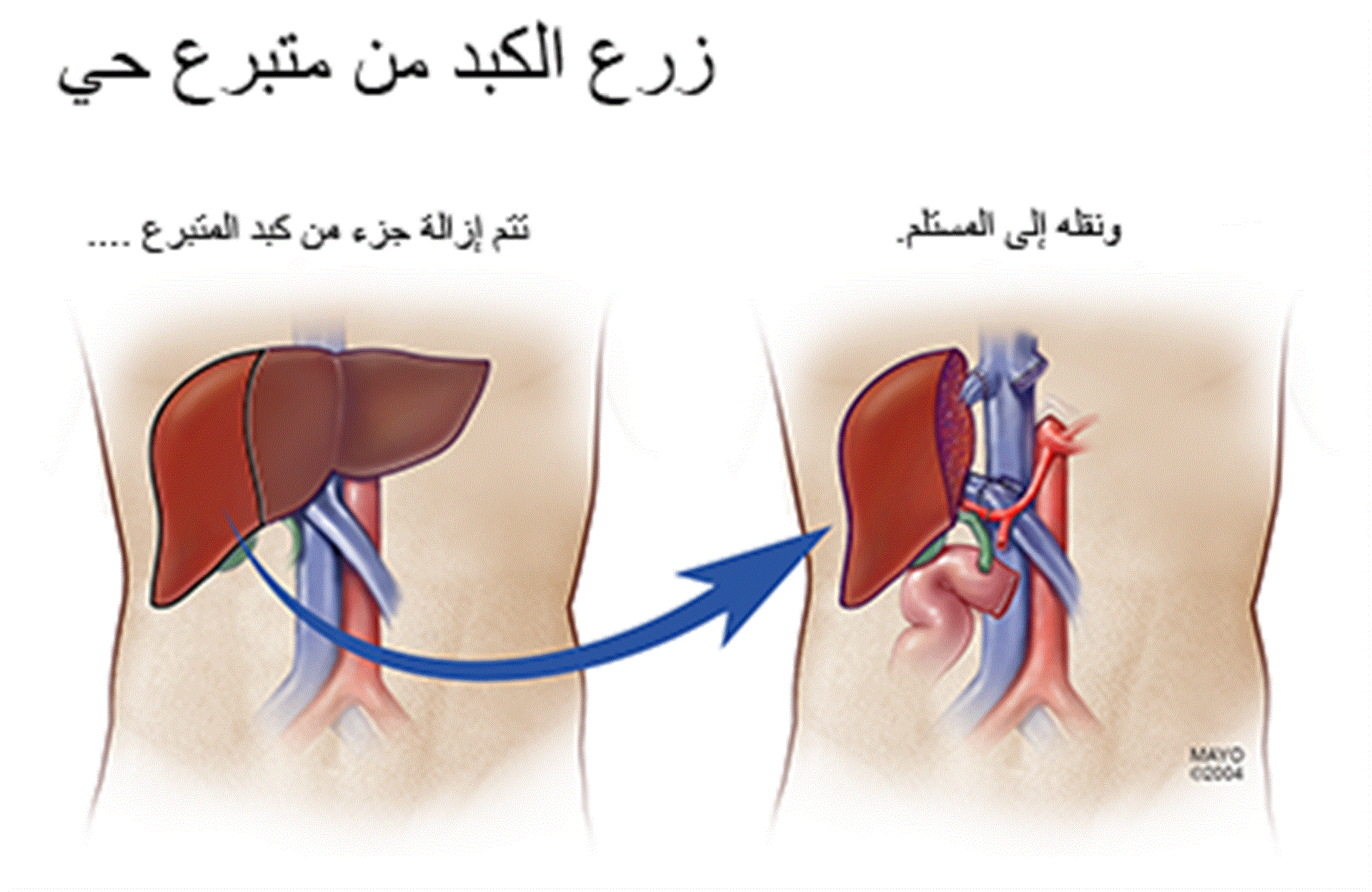 علاج تليف الكبد - اعراض وعلاج تليف الكبد 4036