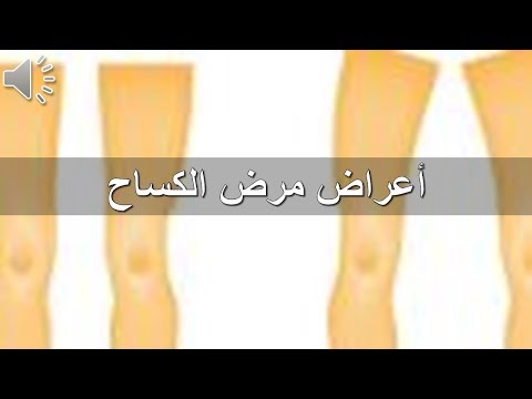 مرض الكساح - علاج مرض الكساح 0 8