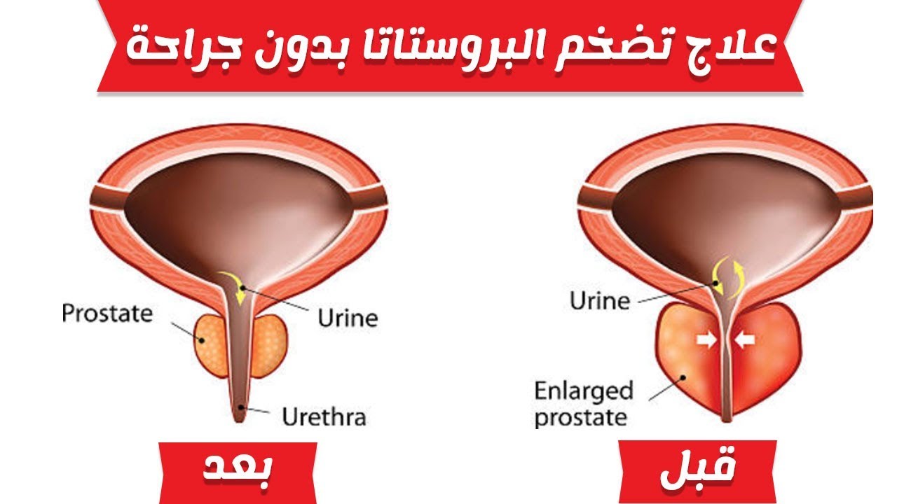 علاج تضخم البروستاتا - تضخم البروستاتا واهم اسبابها وطرق علاجها 4557 2