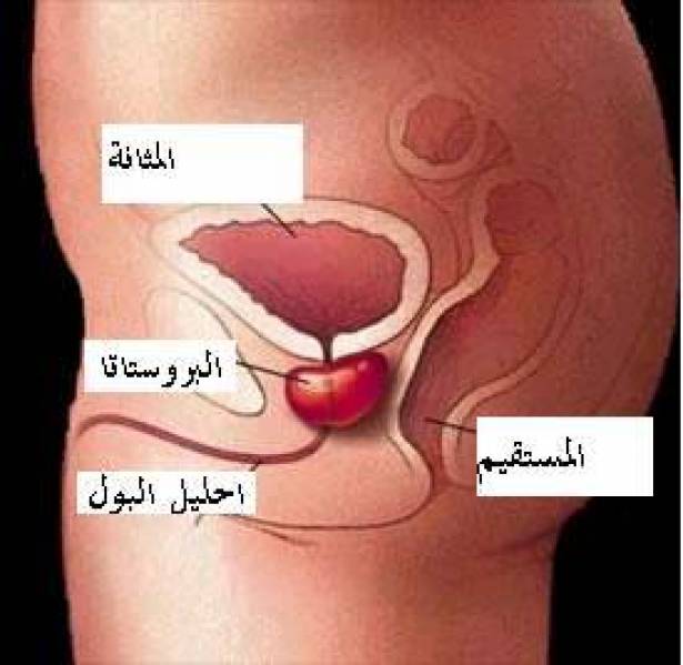 علاج البروستاتا - اهم ما يمكن معرفته لعلاج البروستاتا 994 2