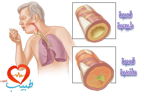 اسباب ضيق التنفس - هل هو عرض ام مرض- 5755 11