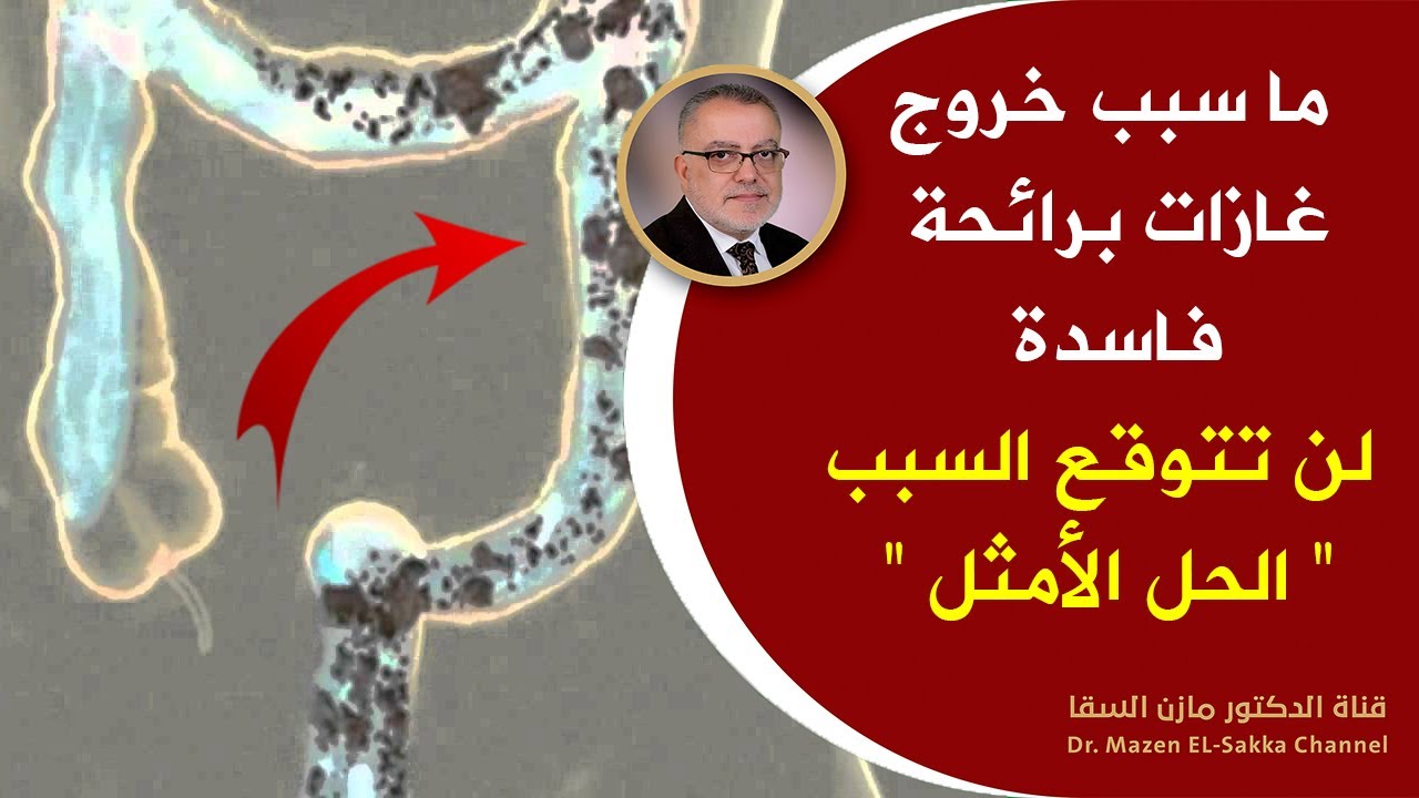 كثرة خروج الريح من الدبر - تعرف على اسباب خروج الغازات 10681 2