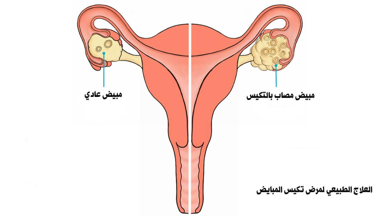 علاج ضعف المبايض 3492 10