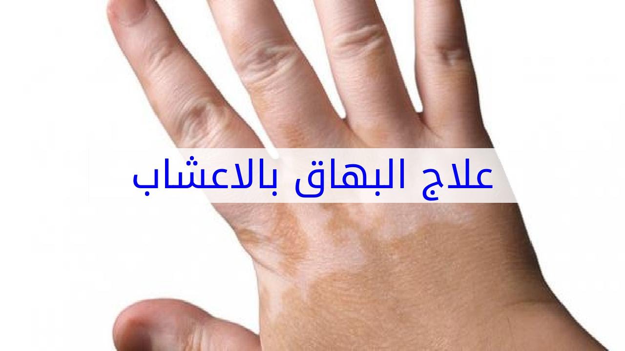 علاج البهاق بالاعشاب - وصفه مضمونه ومجربه لعلاج البهاق 3170 1