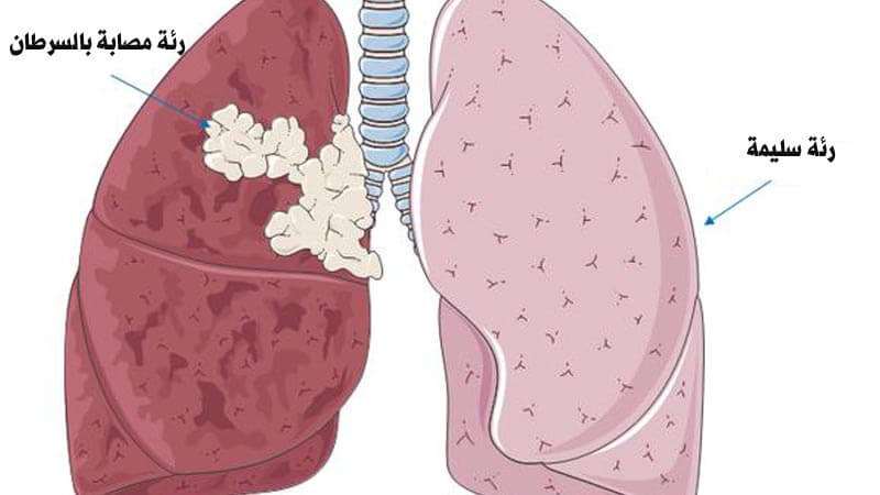اعراض سرطان الرئة - طريقة تشخيص سرطان الرئة 2241 1