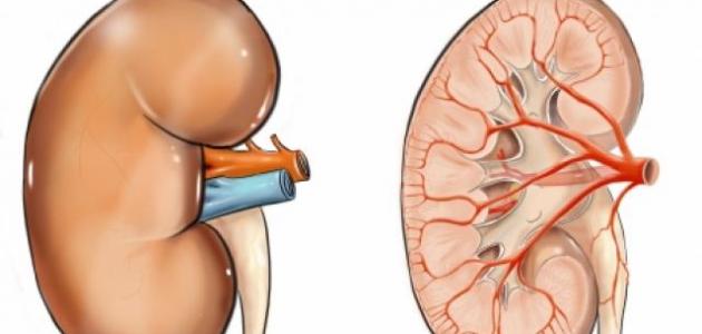 كيفية علاج رمل الكلى , علاج رمل الكلى