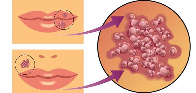 مرض الهربس - ما هو مرض الهربس و علاجه 2312 1