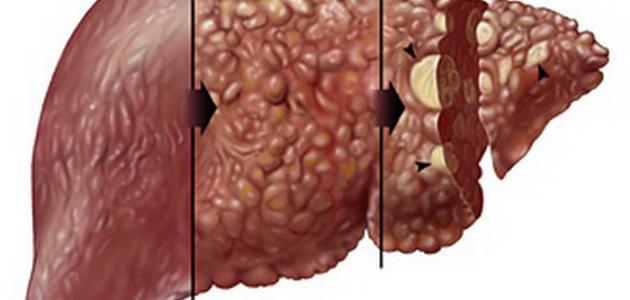 اضرار تليف الكبد - اعراض تليف الكبد 2483