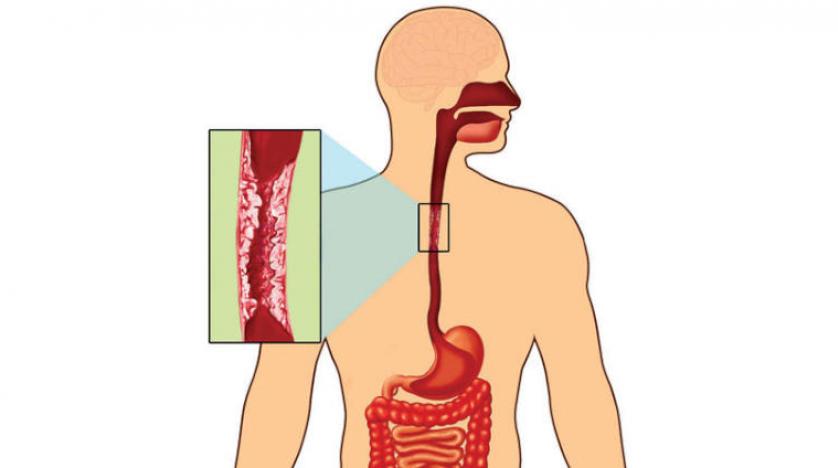 تشخيص سرطان المريء - اعراض سرطان المريء 1448