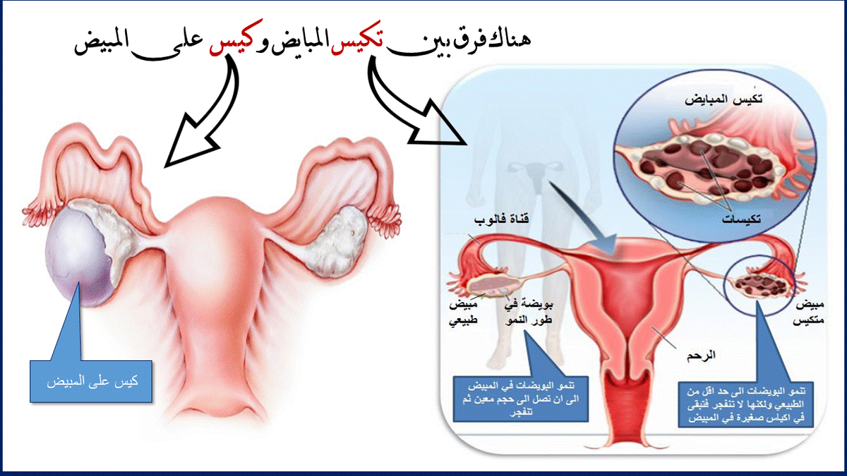 اعراض تكيس المبايض - ما هو تكيس المبايض 6487