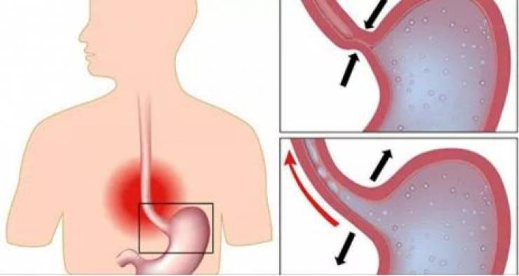 ما هو المريء - هو الجزء المسئول عن نقل الطعام الى المعدة فمن هو 10658