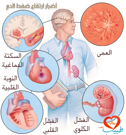 علاج ارتفاع ضغط الدم - طرق مجربة ومضمونة لعلاج ارتفاع ضغط الدم 2938 1