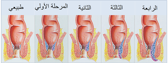 مرض البواسير - اسبابة واعراضة وعلاجة 2645