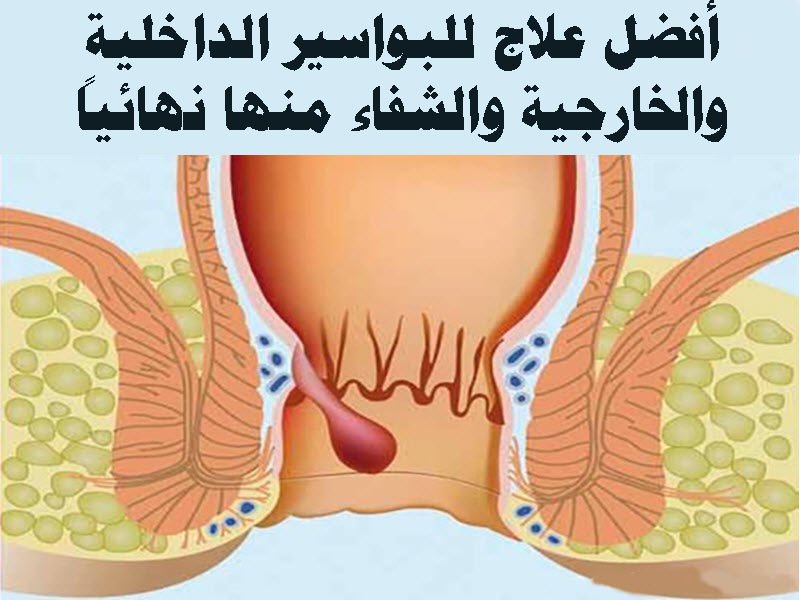 علاج البواسير - كيف تتخلص من البواسير 2516