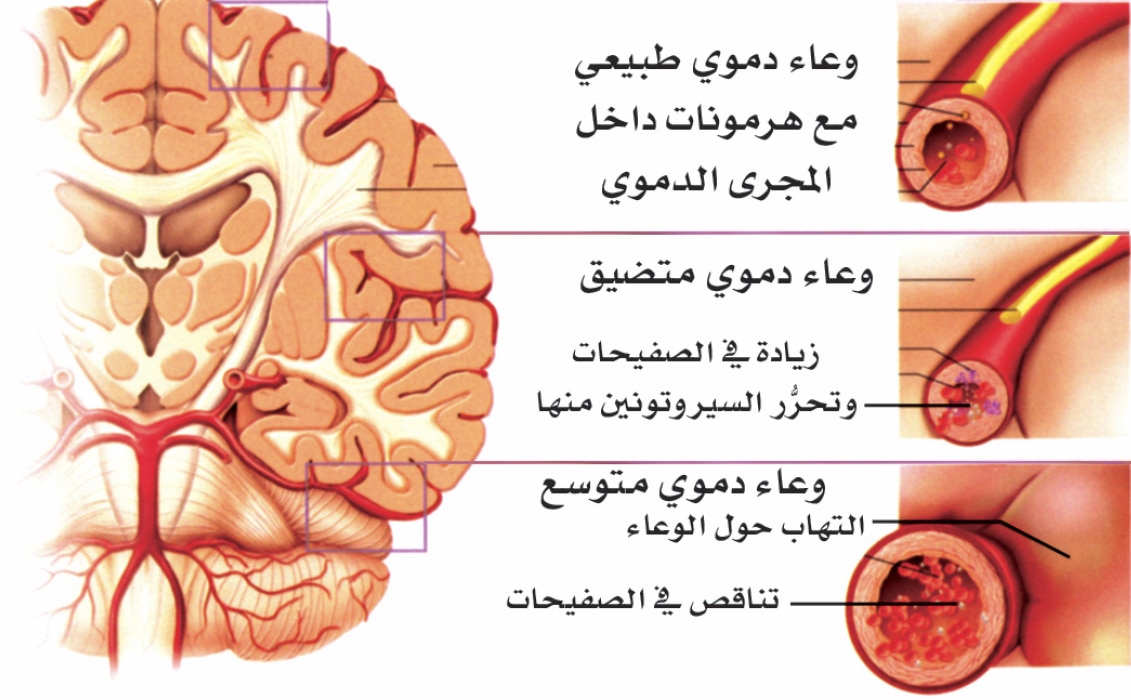 مرض الشقيقة - ما هو مرض الشقيقة 4773 1