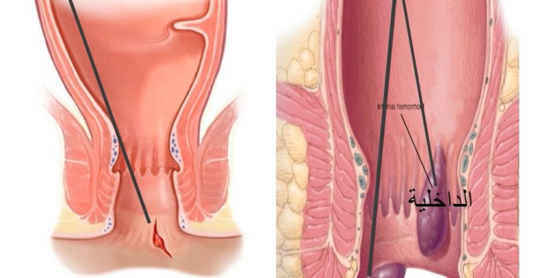 علاج البواسير - كيف تتخلص من البواسير 2516 1