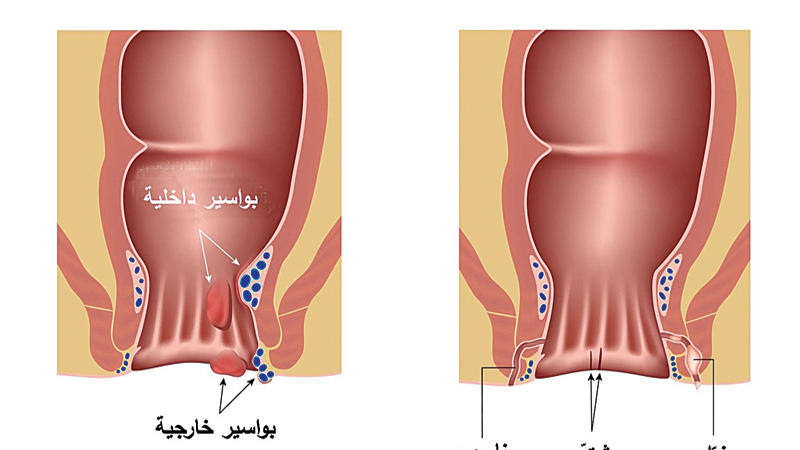 ما هو الناسور